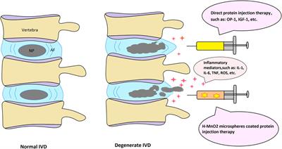 Can Manganese Dioxide Microspheres be Used as Intermediaries to Alleviate Intervertebral Disc Degeneration With Strengthening Drugs?